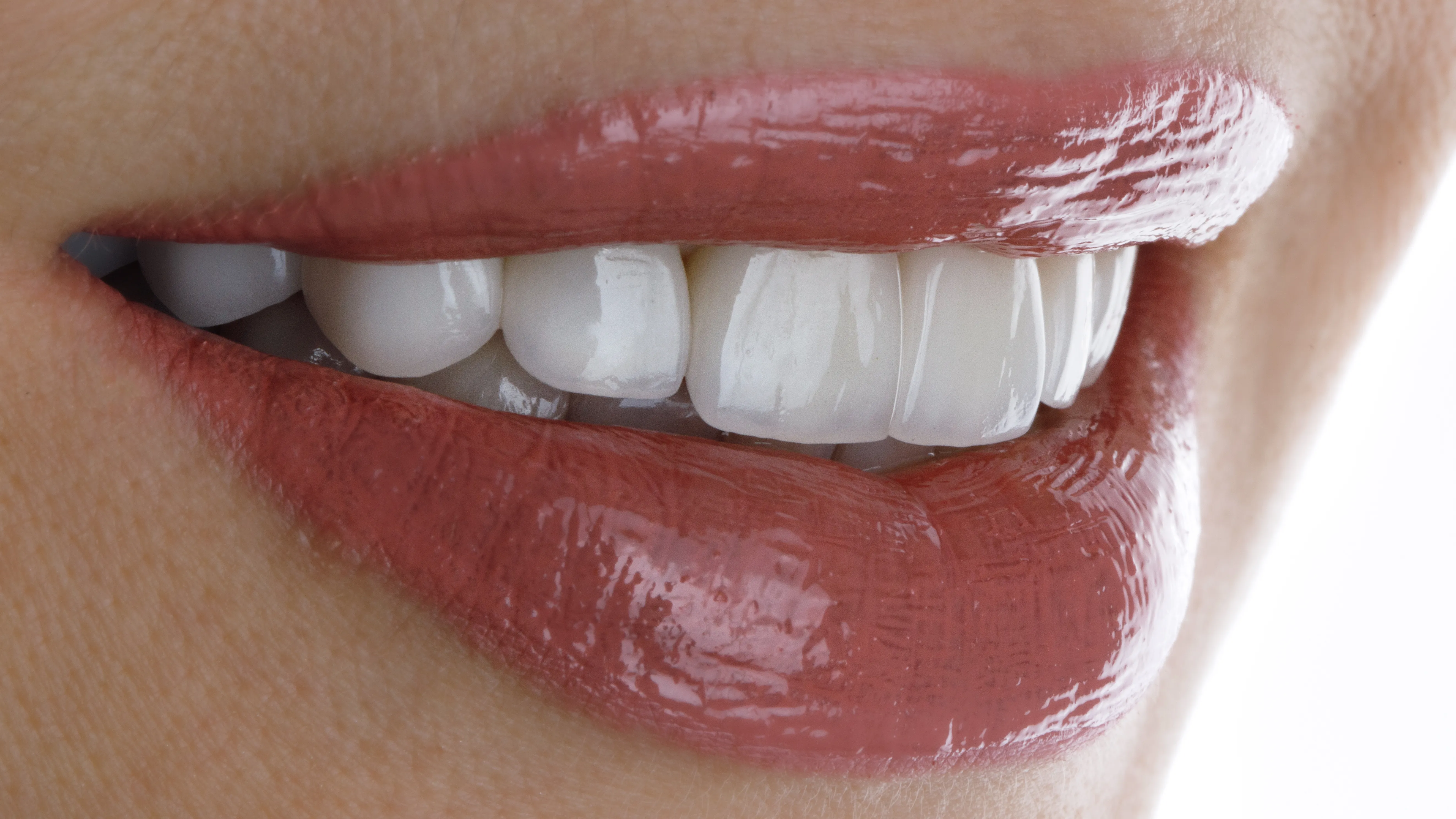 Hollywood Smile (Gülüş Tasarımı)
