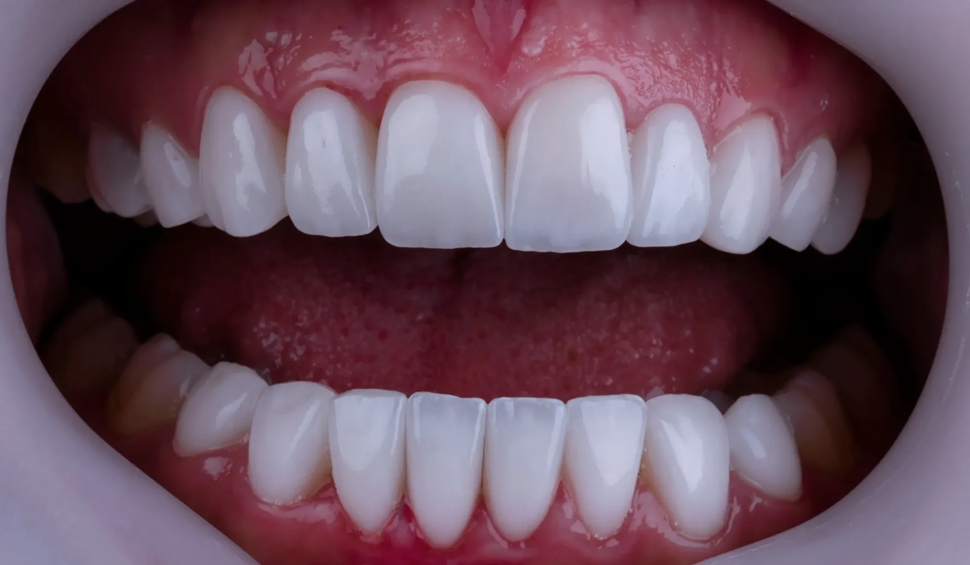 Full-Mouth (Komple Diş Yapımı)