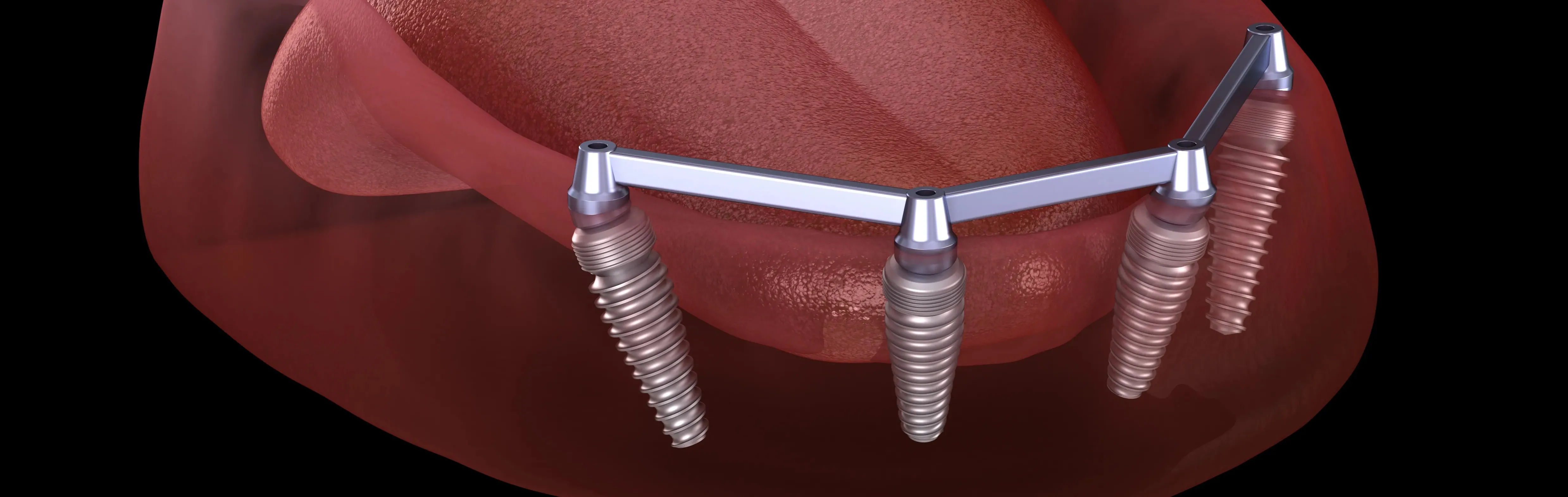 all on four implant all on four implant