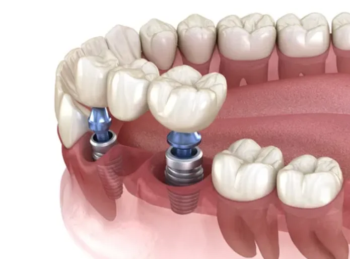 implant üstü zirkonyum kron