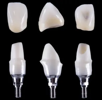 implant üstü diş