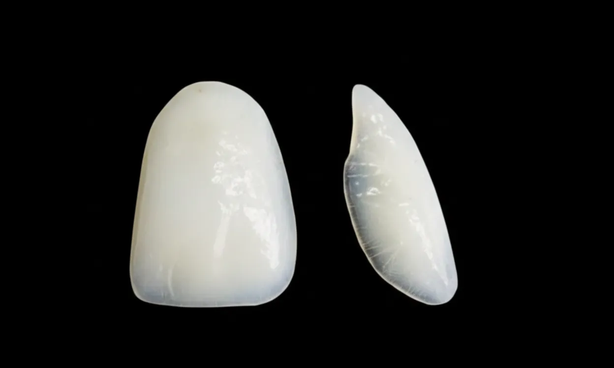 lamina diş kaplaması