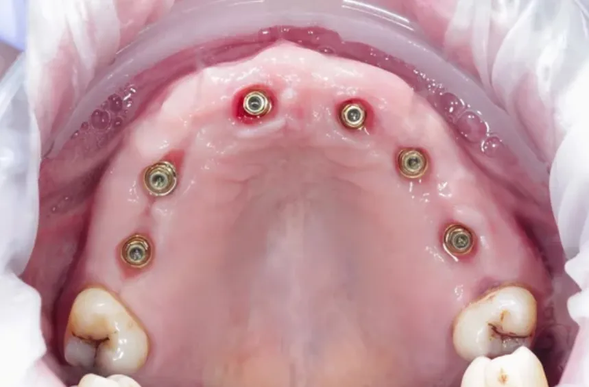 implant üstü titanyum bar