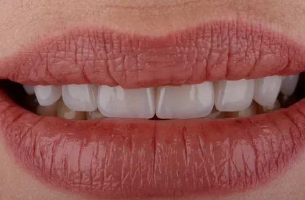 hollywood smile gülüş tasarımı