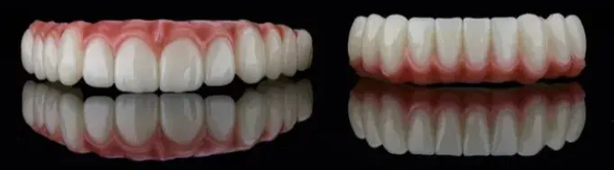 implant üstü bar